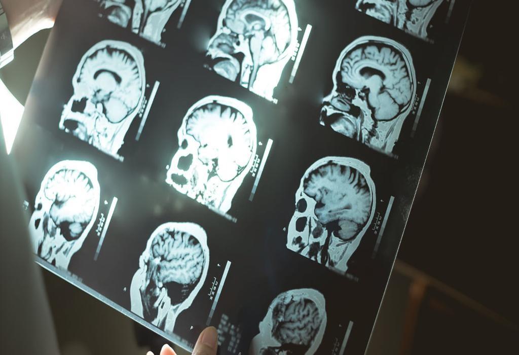 تحقیق جدید درباره رابطه چربی احشایی و شناخت در افراد سالمند