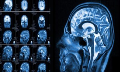 بررسی تاثیر التهاب بر افسردگی و اختلال در سیستم پاداش مغز