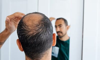 بهترین درمان ریزش مو از دیدگاه متخصصان و معرفی جدیدترین روش ها