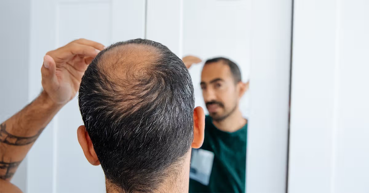 بهترین درمان ریزش مو از دیدگاه متخصصان و معرفی جدیدترین روش ها