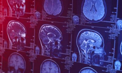 مرگ زودهنگام و اهدای مغز؛ بررسی زوال عقل در جوانان