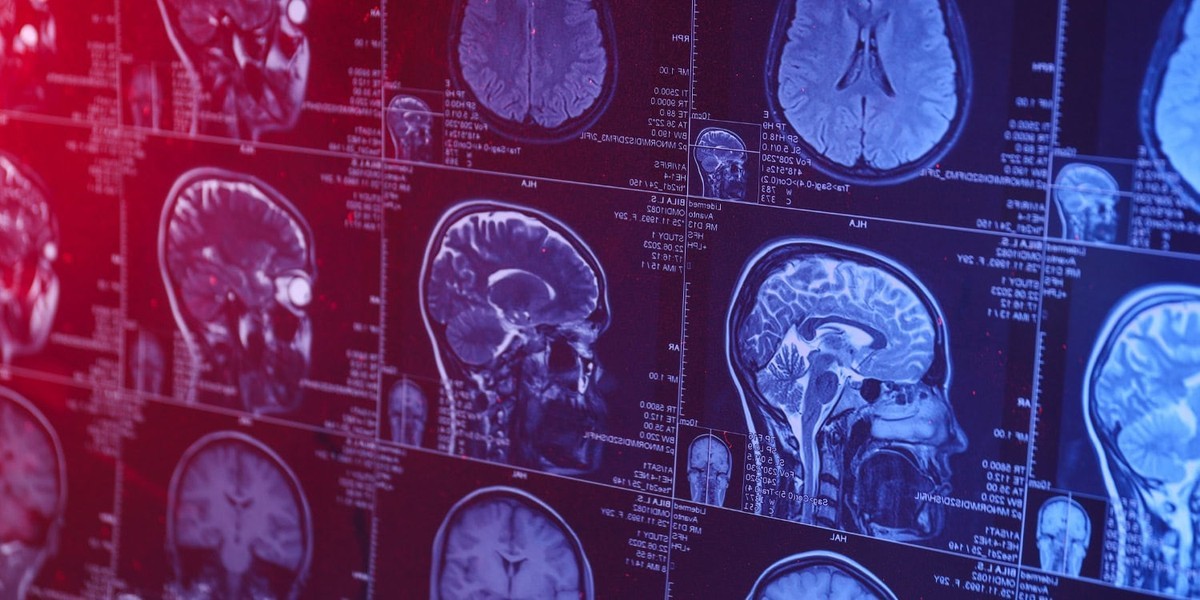 مرگ زودهنگام و اهدای مغز؛ بررسی زوال عقل در جوانان