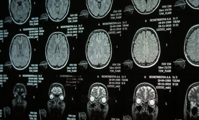 تأثیر خواب نامنظم بر مغز نوجوان و تغییرات ساختاری ناشی از آن