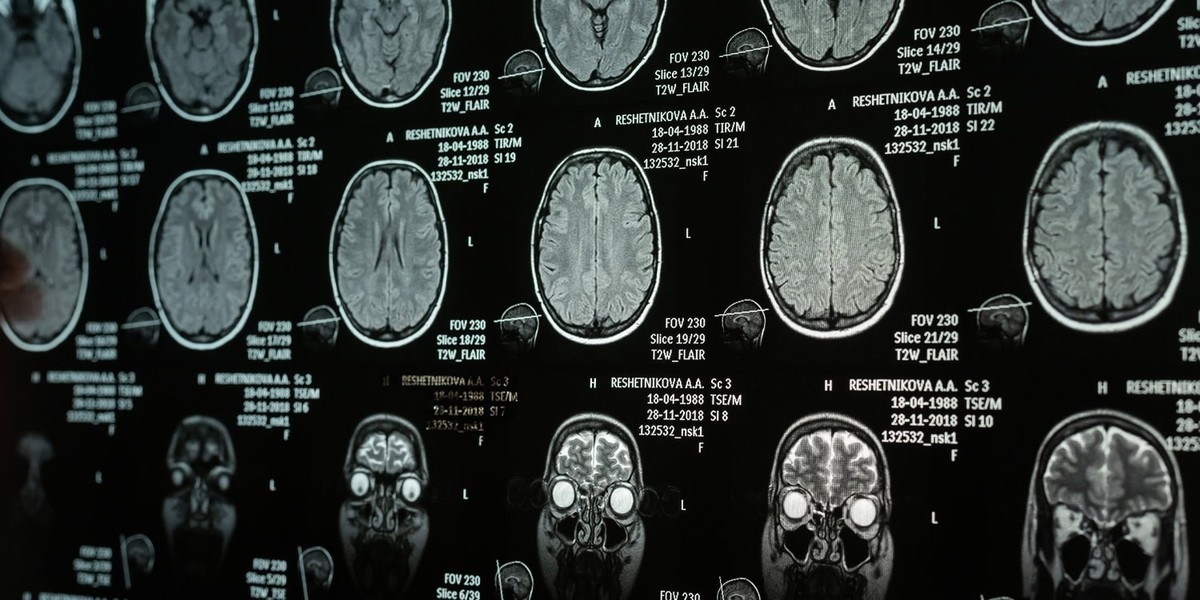 تأثیر خواب نامنظم بر مغز نوجوان و تغییرات ساختاری ناشی از آن