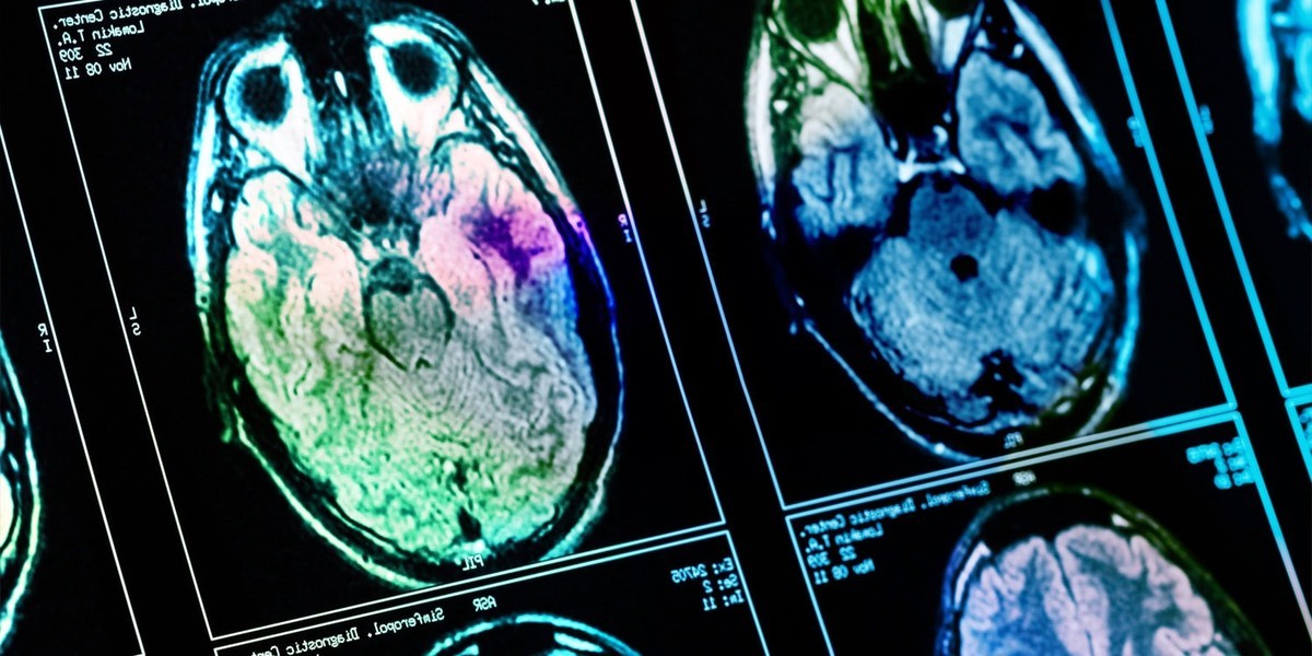 بررسی علمی تأثیر درآمد بر مغز در پردازش پاداش و استرس