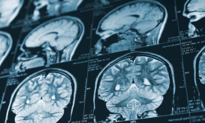 آسیب های کودکی و پیری مغز؛ چگونه تروما روند پیر شدن ذهن را تغییر می دهد؟