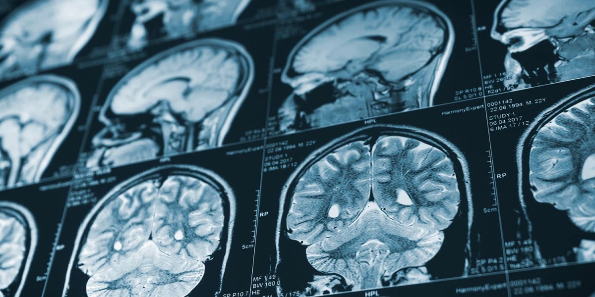 آسیب های کودکی و پیری مغز؛ چگونه تروما روند پیر شدن ذهن را تغییر می دهد؟