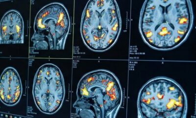 تحلیل تفاوت های جنسیتی در خشونت و افسردگی نوجوانان و نقش مغز