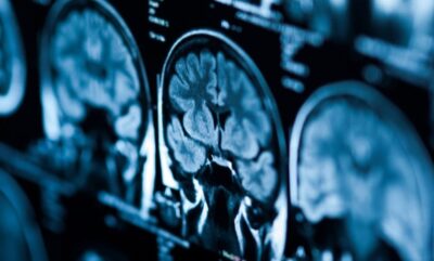 بررسی علمی تغییرات مغز در دوقطبی هنگام افسردگی و بهبودی