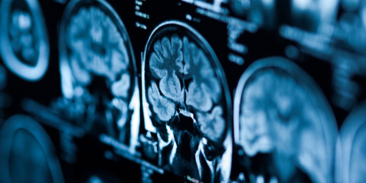 بررسی علمی تغییرات مغز در دوقطبی هنگام افسردگی و بهبودی