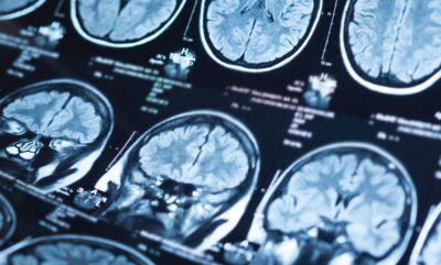 نقش خواب در ترک الکل و بررسی تأثیر بی خوابی بر تشدید احساسات منفی