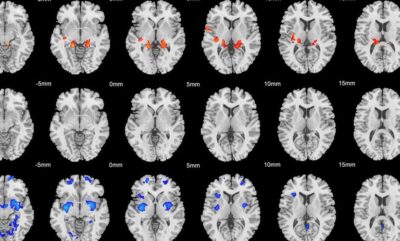 تقسیم بندی جدید بیش فعالی بر اساس تفاوت های ساختاری مغز