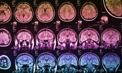 تحلیل اثر بدرفتاری کودکی بر رشد مغز و تفاوت های جنسیتی آن