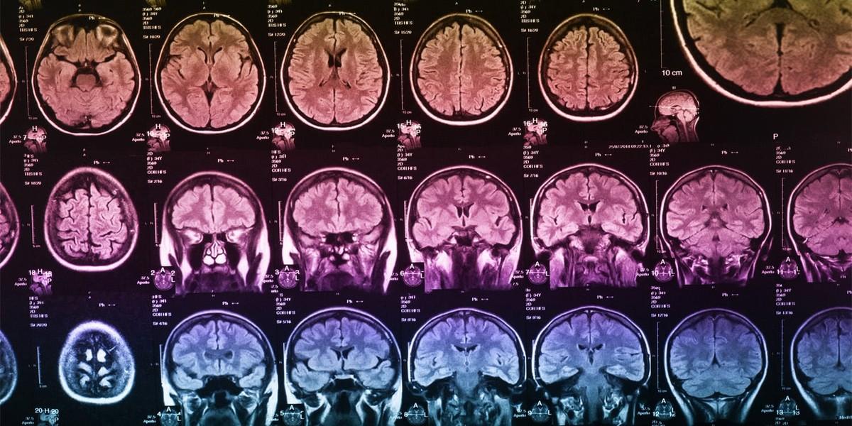 تحلیل اثر بدرفتاری کودکی بر رشد مغز و تفاوت های جنسیتی آن